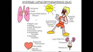 A Class On SLE By Dr VasunadaraDept Of Paediatrics