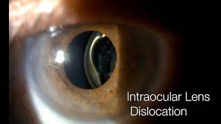 Yamane Technique  Intraocular Lens Dislocation  IOL Exchange  Tijuana Mexico