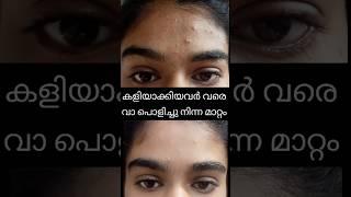 remove pimplesfade acne marks മുഖക്കുരു പോയിയെന്ന് ഞാൻ ചങ്കൂറ്റത്തോടെ പറയും #shortsvideo