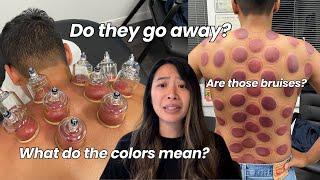 What They DONT Tell You About Cupping Marks...