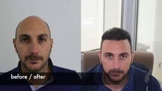 Hair transplant before after FUE Hair transplant