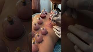 Hijama cupping therapy