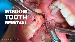 Wisdom tooth removal in 5 MIN or less. Surgical Guide Online Course + Free e-Book