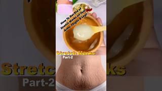 Stretch Marks Removal Part 2