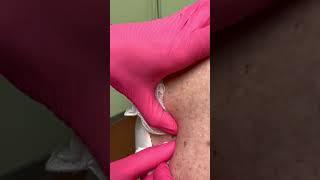 Original Short Video of Open Comedones Treated By Dr. H.L. Greenberg at Las Vegas Dermatology