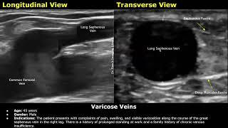 Varicose Veins Doppler Ultrasound Report Example  Lower Limb Venous Insufficiency Sonography USG