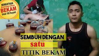 TUSUK JARUM punggung pundak pinggang pegal sakit - BEKAM DARAH CUPPING