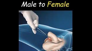 How To Change Male Gender To Female...Gender Reassignment Surgery 2020