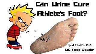 Can Urine Cure Athletes Foot?