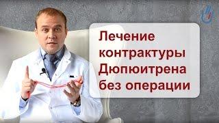 Лечение контрактуры Дюпюитрена без операции