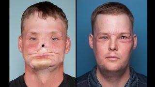 Man receives face transplant after suicide attempt