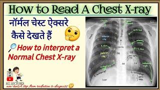 How to read a chest x-ray  Normal chest x-ray interpretation  चेस्ट PA ऐक्सरे कैसे देखे Chest-PA