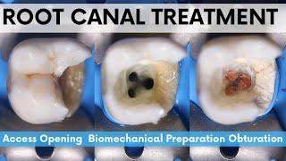 Root Canal TreatmentMandibular 2nd Molar🟡Access Opening🟢 Biomechanical Preparation️Obturation