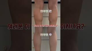 종아리 알 빼기 스트레칭 일주일 변화는? #shorts