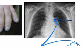 Tuberculosis  Clinical Presentation  Lab Diagnosis