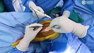 total knee replacement surgery video @ConceptualOrthopedics