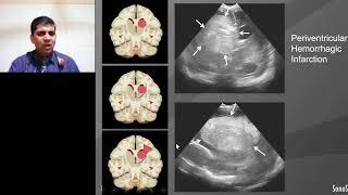 Webinar Point-of-Care Neonatal Ultrasound