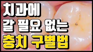 충치 자연치유? 치과 진료가 필요 없는 충치 구별법 feat.과잉 진료 방지법