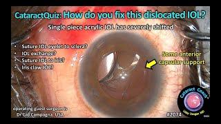 CataractCoach™ 2074 Quiz how do you fix this dislocated IOL?