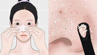 Giveaway Event ASMR Melt nose sebum and squeeze it out  Blackheads Pimple Popping LULUPANG