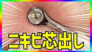 ニキビ芯出し・ニキビ潰す動画　acne treatment in Japan