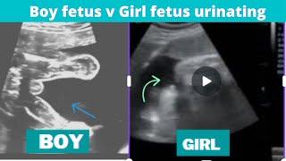 Baby girl vs baby boy captured urinating inside womb on Ultrasound