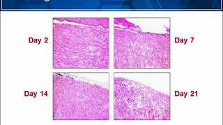 Regenerative Tissue Matrix in Treatment of Wounds