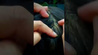 Scratching Dandruff Removal 