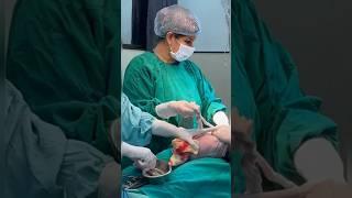 Cesarean section delivery ‼️Dr. Nikita Kalda #shortvideo #shorts #baby #birth #newbornbabyb #shorts