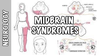 Midbrain Syndromes - Weber’s Syndrome Benedikt’s Syndrome and Parinaud Syndrome.