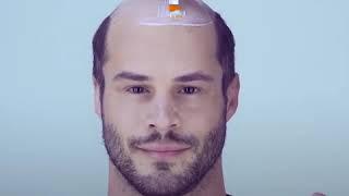 Ultra realistic hair pieces give bald men hair again