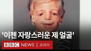 안면 기형으로 친부모에게 버림받았던 아이는 어떻게 자랐을까? - BBC News 코리아