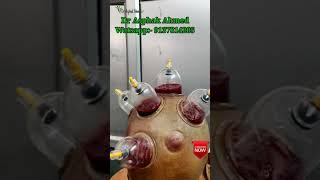 hijama treatment for hair regrowth  Cupping Therapy VedioHijama in Lucknow Dr Asphak Ahmed