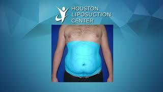 Liposuction for Men  Liposuction Before & After