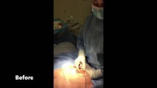 Dr. Sandra McGill  Plastic Surgeon  Vertical Breast Lift