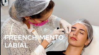 Preenchimento Labial com Ácido Hialurônico