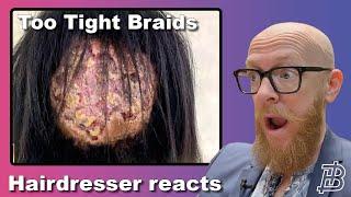 She LOST HER HAIR from TIGHT BRAIDS  Hairdresser reacts to Hair Fails