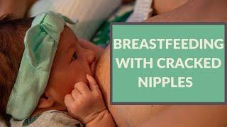 How to Continue Breastfeeding When your Nipples are Cracked Blistered or Painful