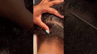 Scratching a Patch of Dandruff  Flaky Scalp #dandruffremoval #scalp scalpscratch #itchyscalp