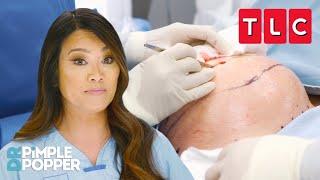 Biggest Removals Ever  Dr. Pimple Popper  TLC