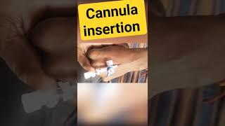 self practice of cannula insertion #doctor #viral #YouTube #medicine #youtubeshorts