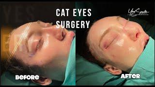 CAT EYES SURGERY   FOX EYES WITH  OP. DR. YÜCEL SARIALTIN