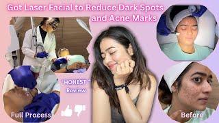 Got Laser Facial To Reduce Dark Spots and Acne Marks  *HONEST REVIEW*  Gauri Gajare Official