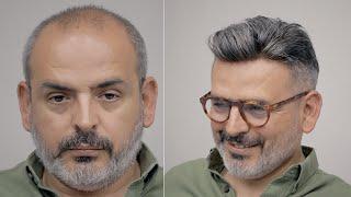 PROTEZ SAÇ İLE GENÇ KAL - Hair Replacement