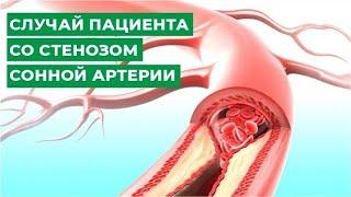 Случай пациента со стенозом сонной артерии