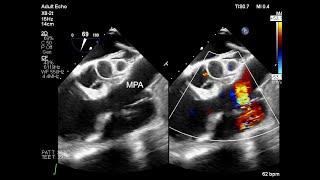 Coronary Artery Fistula With Transesophageal Echocardiography