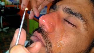 blackheads removal sac dep spa 2024  How to remove blackheads from face   asghar barbershop video