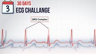 Day 3 QRS complex In Action  30-Day ECG Challenge
