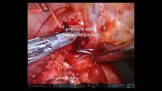 Asvide Details of management for intraoperative complications.