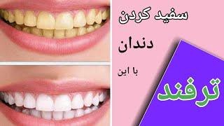 سفید کردن دندان در خانه - سفید شدن دندانها در یک روز